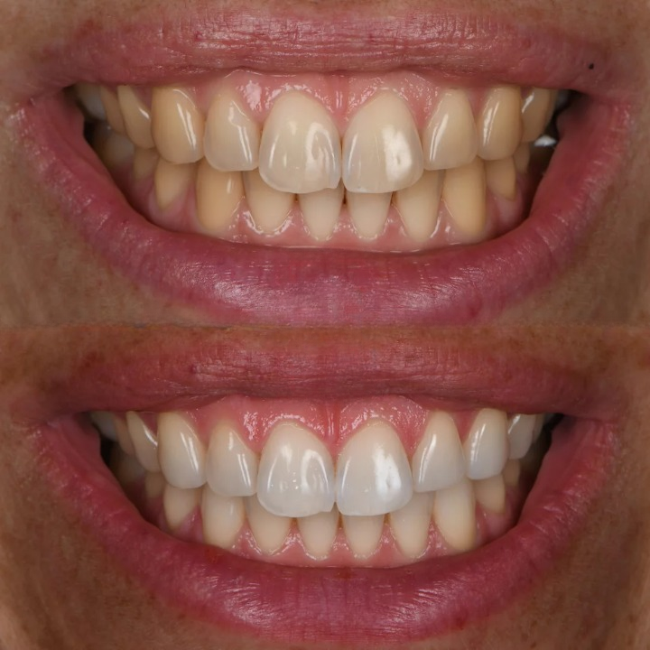 Dents blanches sans dentiste / Avant Apres