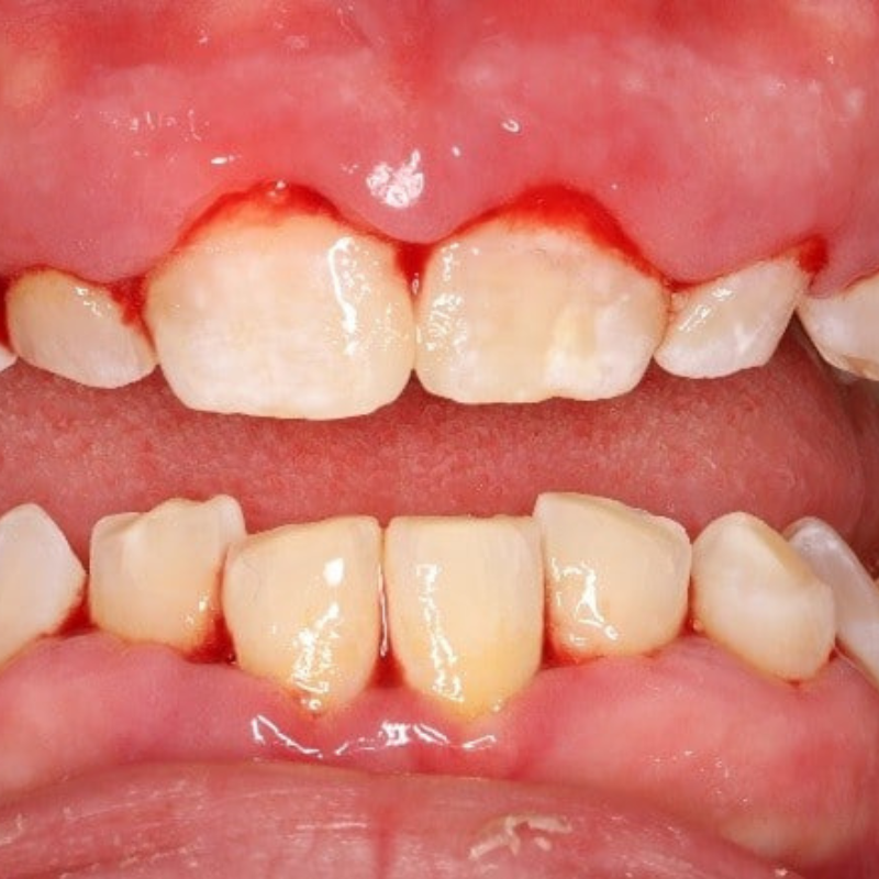 Gencives qui saignent : faut-il s’inquiéter ?