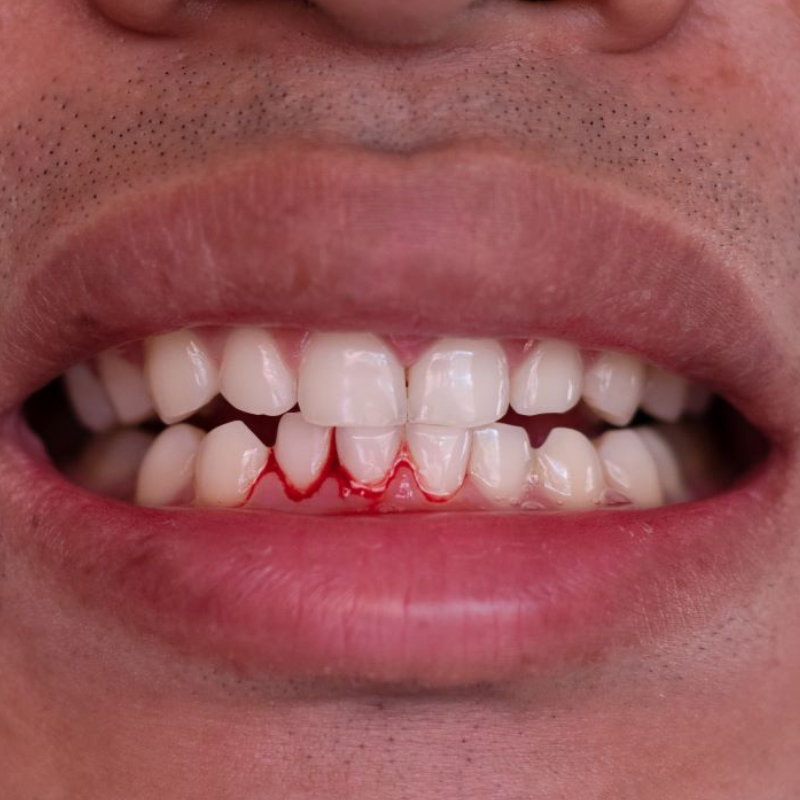 Gencives qui saignent : 9 causes fréquentes et les solutions validées par les dentistes