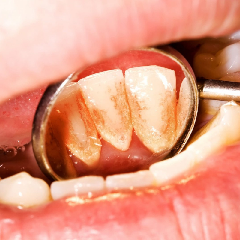 Enlever la plaque dentaire avant qu’elle ne devienne du tartre