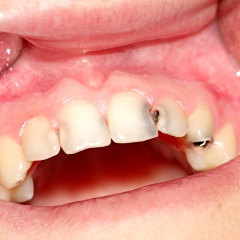 Caries chez l’adulte : pourquoi elles apparaissent encore et comment les éviter