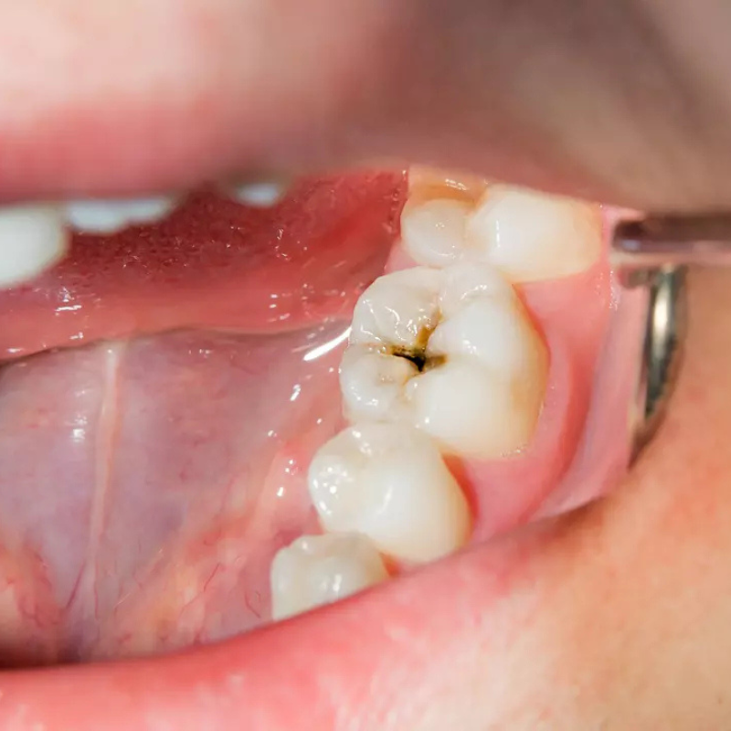 Gros plan sur une dent cariée illustrant les effets de la plaque bactérienne et l’importance d’une bonne hygiène bucco-dentaire avec DentalPro Smile™.