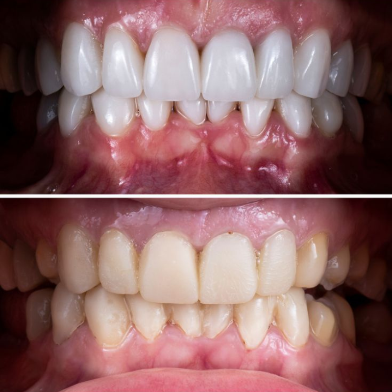 Blanchiment des dents : méthodes naturelles vs solutions modernes