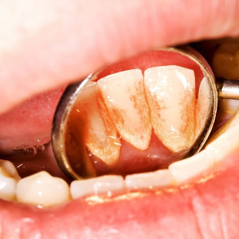 Tartre dentaire : comment l’éliminer efficacement