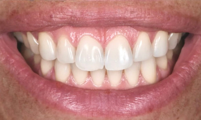 Blanchissement dentaire - Avant - Apres - Nettoyage parfait