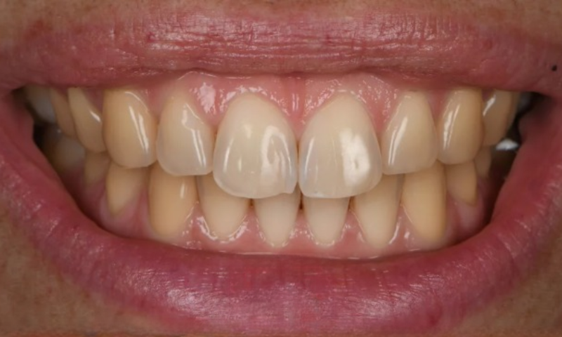Blanchissement dentaire - Avant - Apres - Nettoyage parfait