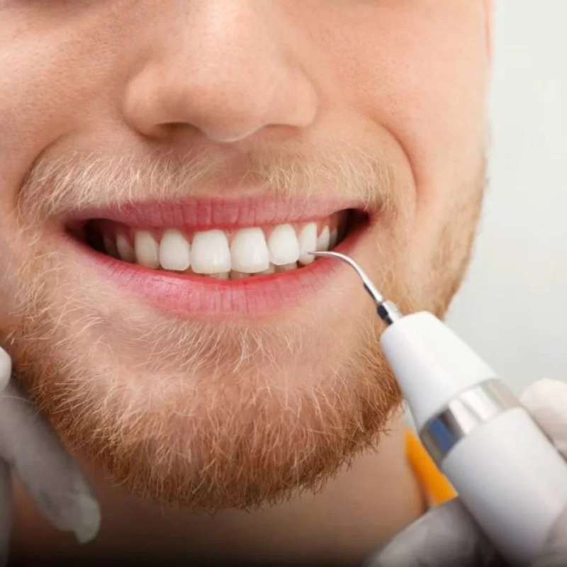 SonicSmile Pro™ – Le Détartreur Sonique Professionnel qui Redonne de l’Éclat à Votre Sourire dès la Première Utilisation !