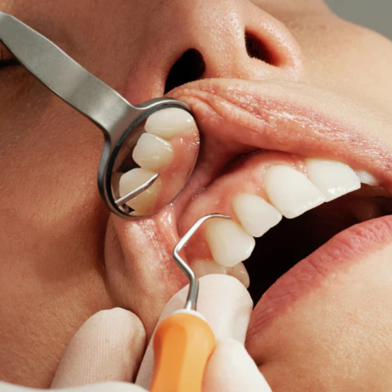 Comment éliminer la plaque dentaire tenace