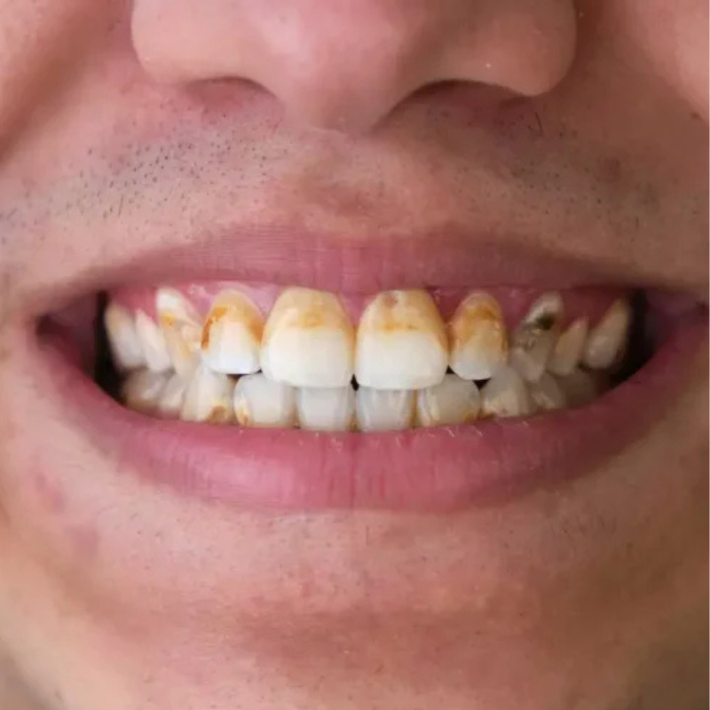 Plaque dentaire : 7 méthodes scientifiquement prouvées pour l’éliminer efficacement (et éviter le tartre)