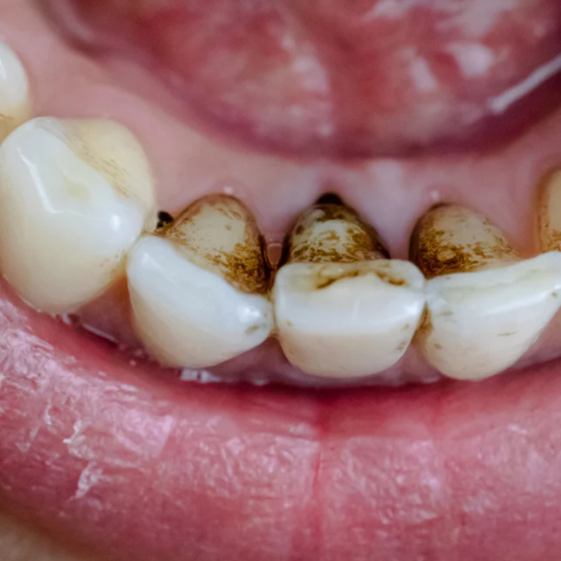 Tartre noir sur les dents : causes, dangers et solutions efficaces en 2026