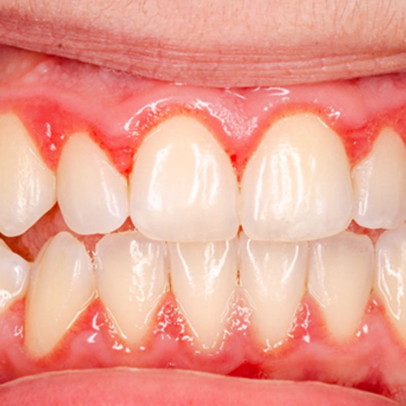 Inflammation des gencives : signes à ne jamais ignorer