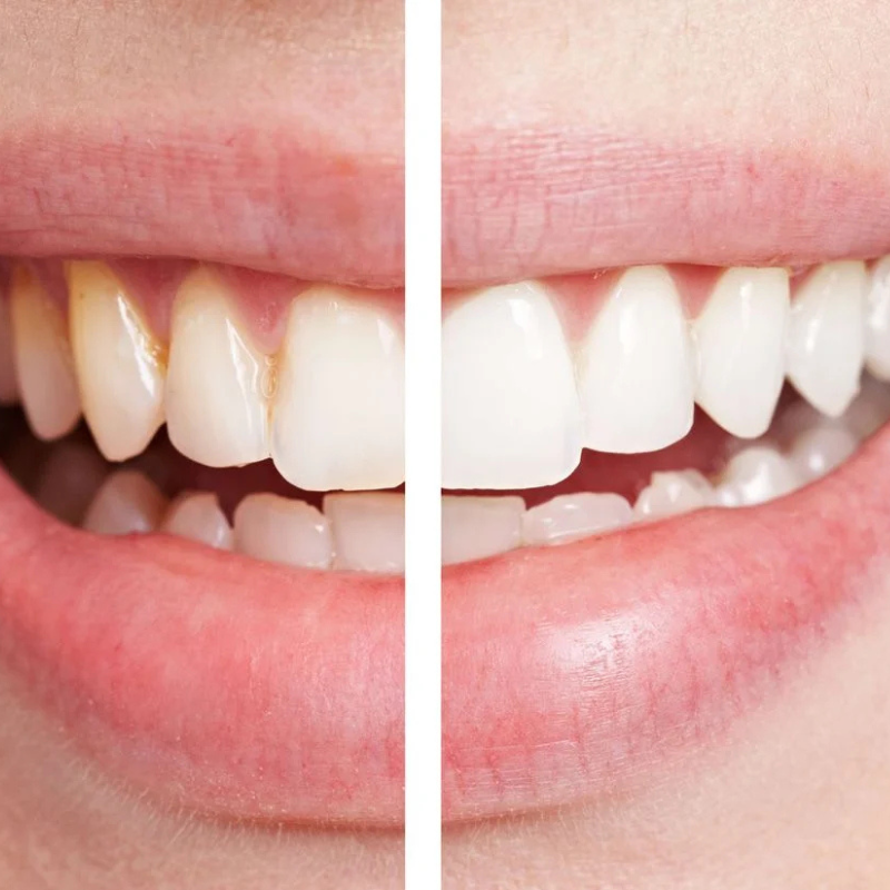 Blanchir ses dents sans abîmer l’émail : ce qu’il faut savoir