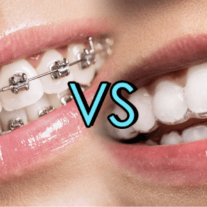 Appareil dentaire ou aligneur dentaire : quel choix pour votre sourire ?