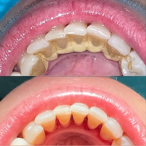 SonicSmile Pro™ – Le Détartreur Sonique Professionnel qui Redonne de l’Éclat à Votre Sourire dès la Première Utilisation !
